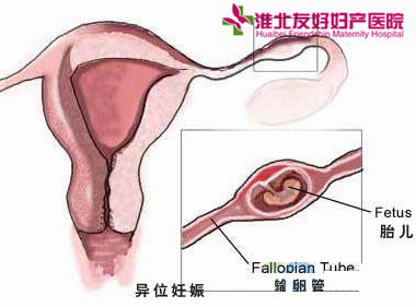 怎么知道是患上了宫外孕