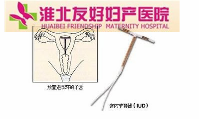 哪些女性不适合做上环手术呢