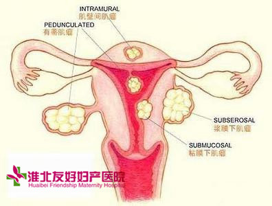 子宫肌瘤多大算严重